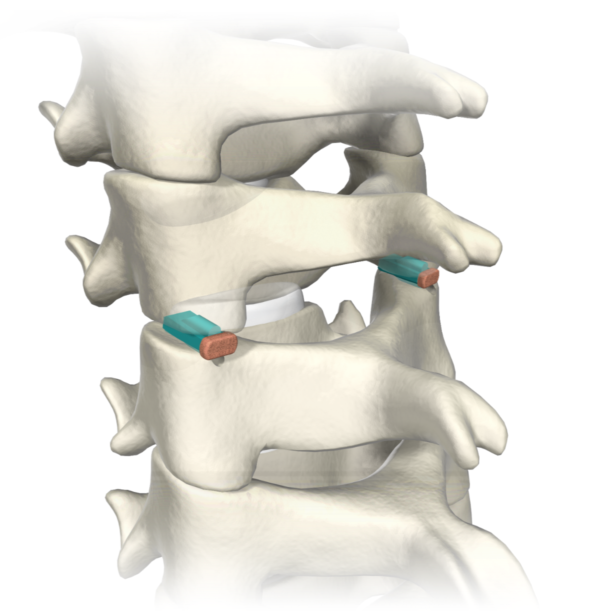 Spinal Implants