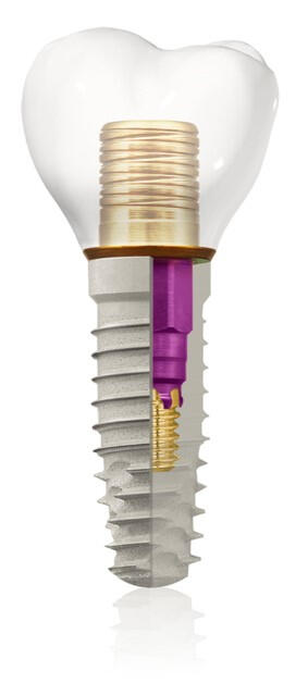 Dental Implants