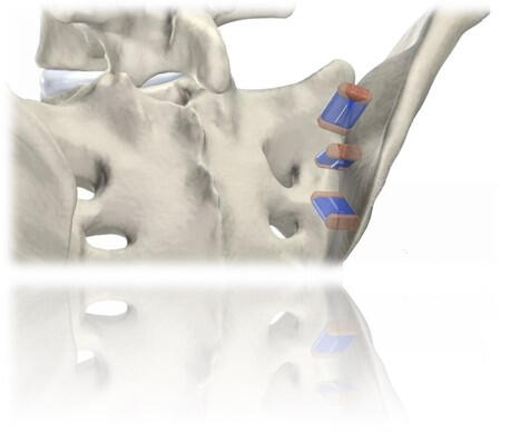 Spinal Implants